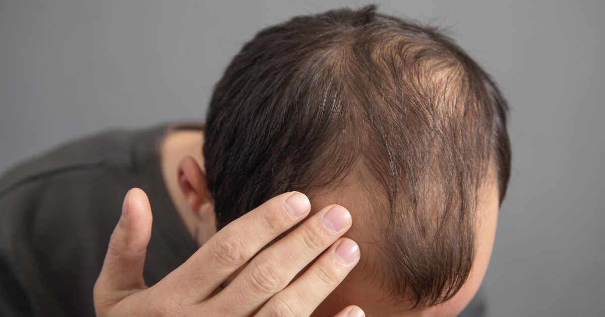 App utiliza inteligência artificial para monitorar calvície